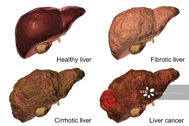 肝脏疾病的各个阶段图示图片素材