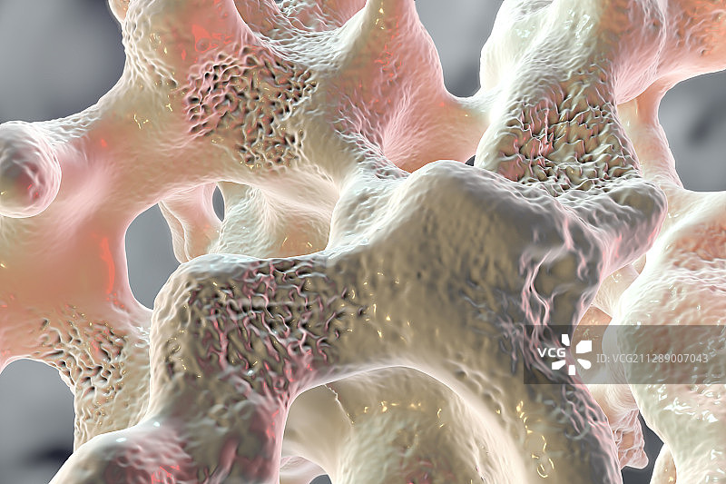骨质疏松症，图示图片素材