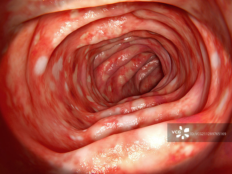溃疡性结肠炎插图图片素材