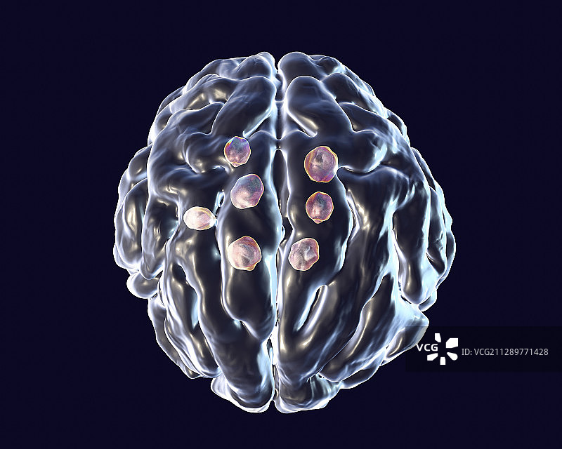 隐球菌性脑损伤，图示图片素材
