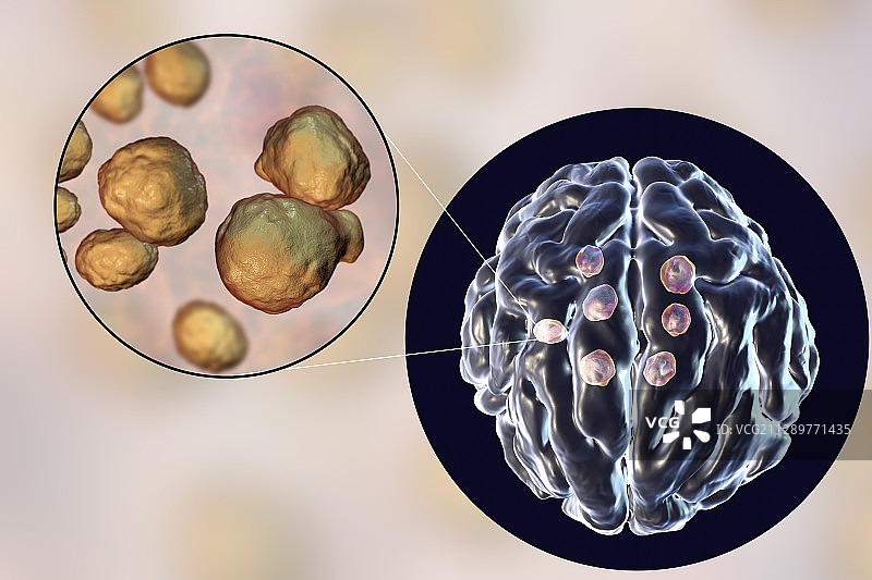 隐球菌性脑损伤，图示图片素材