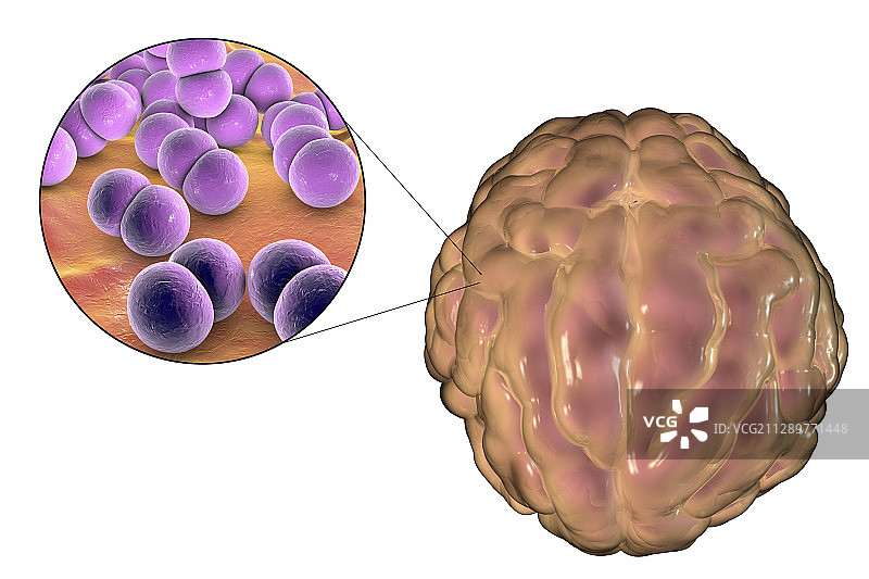 细菌引起的脑膜炎插图图片素材