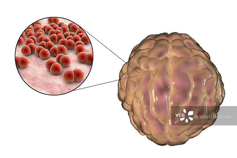 细菌性脑膜炎，图示图片素材