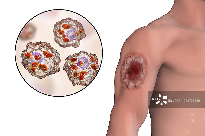 利什曼病皮肤溃疡插画图片素材