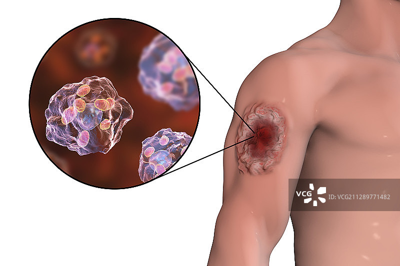 利什曼病皮肤溃疡插画图片素材