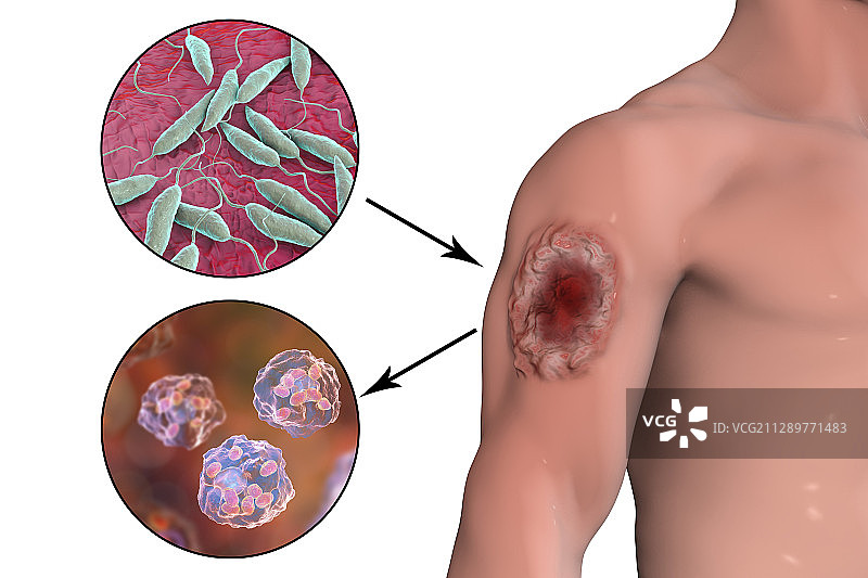 利什曼病皮肤溃疡插画图片素材