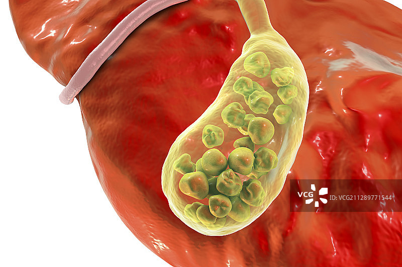 胆结石插图图片素材