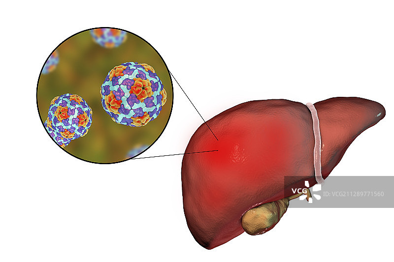 甲型肝炎图示图片素材