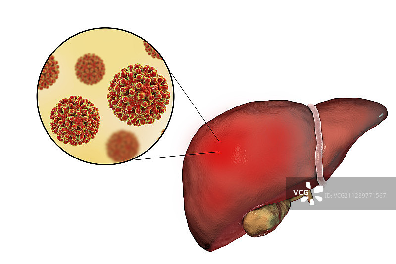 乙型肝炎插图图片素材