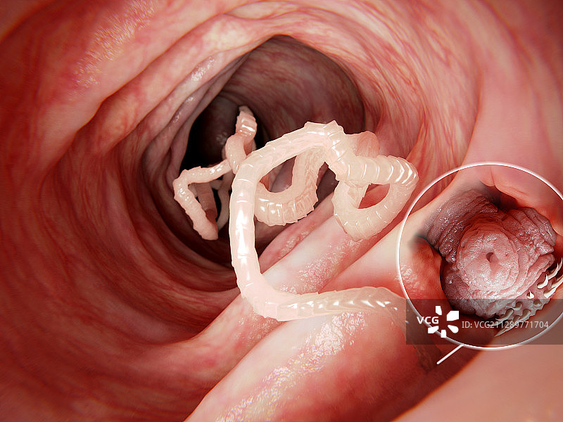 人体肠道中的绦虫插图图片素材