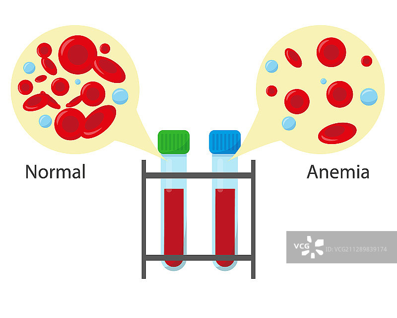 带有正常血液和贫血血液的试管图片素材