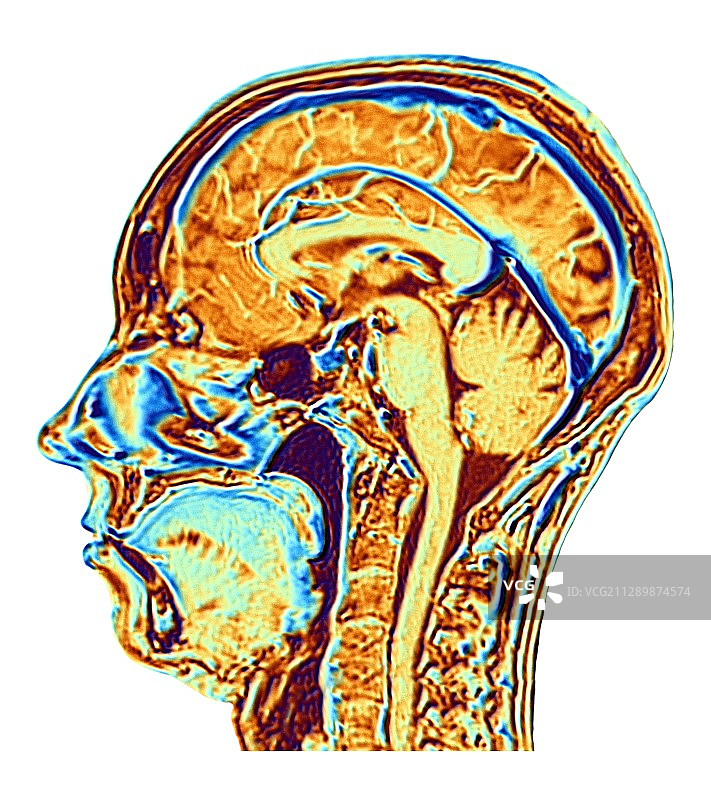 正常脑部核磁共振扫描图图片素材