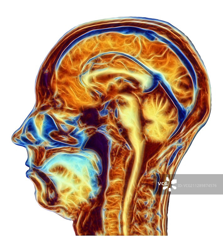 正常脑部核磁共振扫描图图片素材