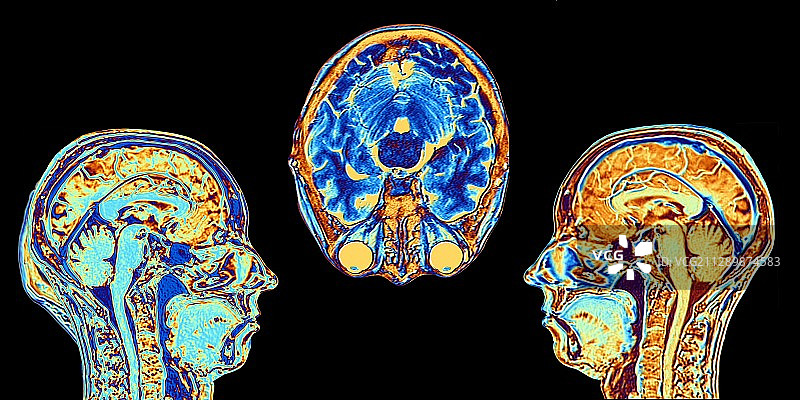 正常大脑的MRI扫描，图示图片素材
