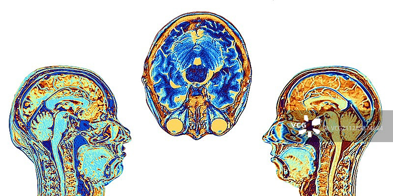 正常大脑的MRI扫描，图示图片素材