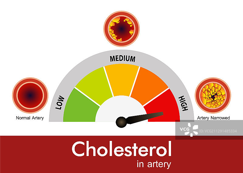 胆固醇在动脉健康风险设计中的作用图片素材