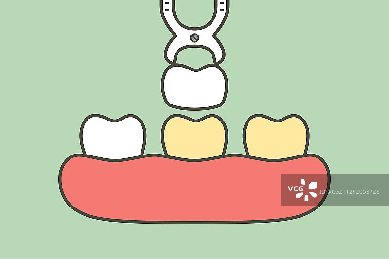 牙科贴面：牙齿美白术图片素材