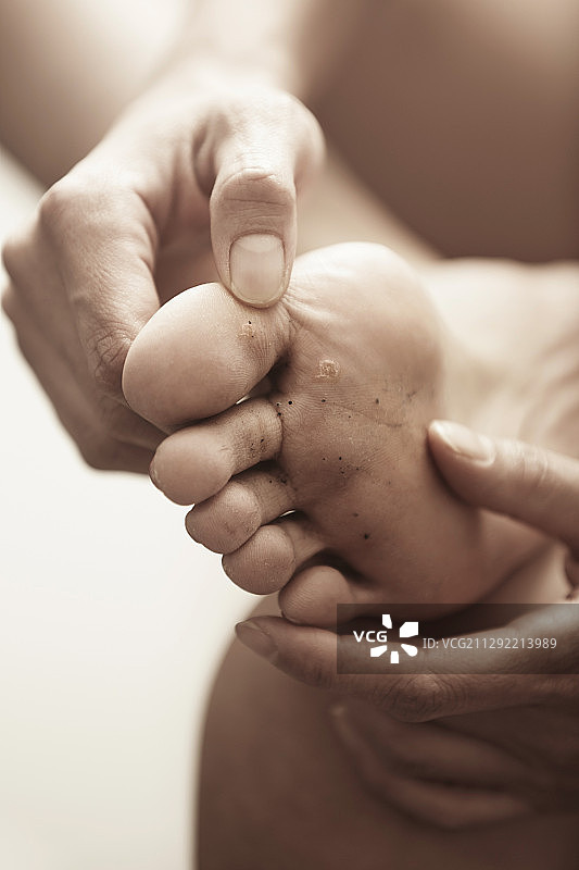 脚部起水泡的女人，竖版照片图片素材
