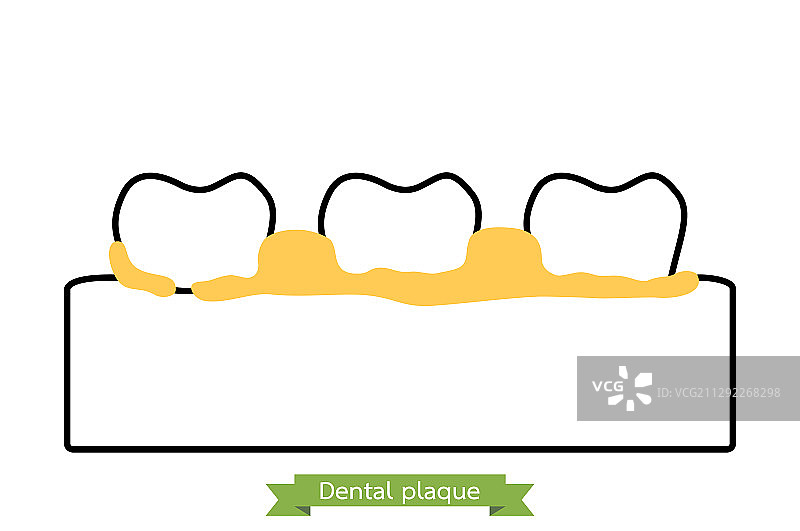 牙菌斑与牙结石——牙周疾病图片素材