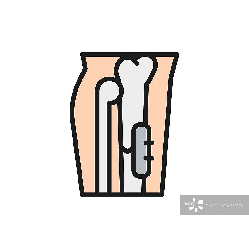 X光显示用医疗器械固定的断腿骨图片素材