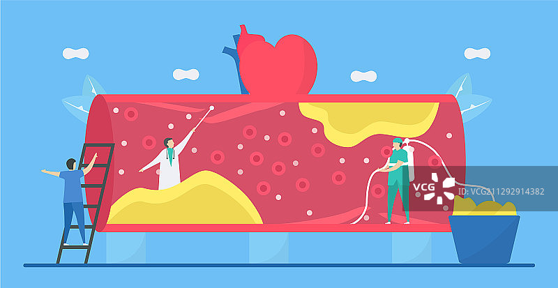 心脏病学：动脉粥样硬化性心脏病图片素材