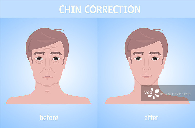 男人面部下巴矫正前后对比图片素材