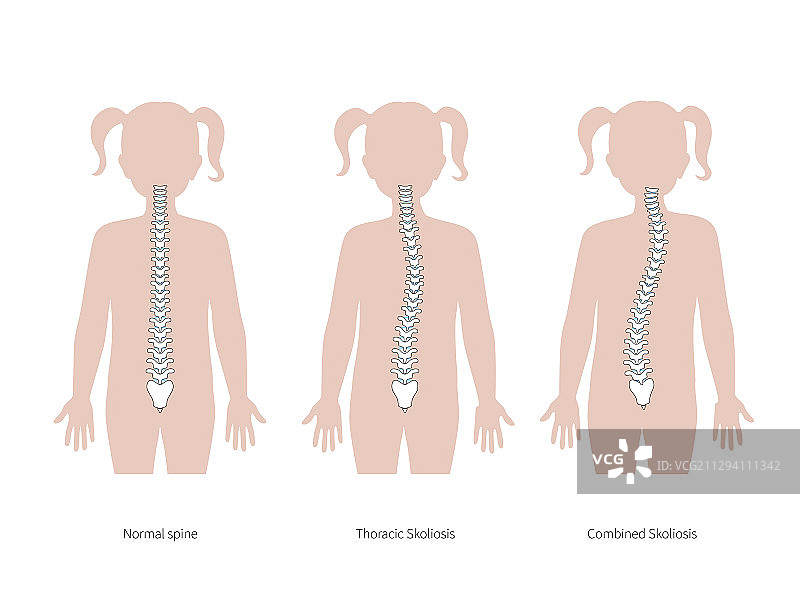 脊柱侧弯扁平风格图片素材