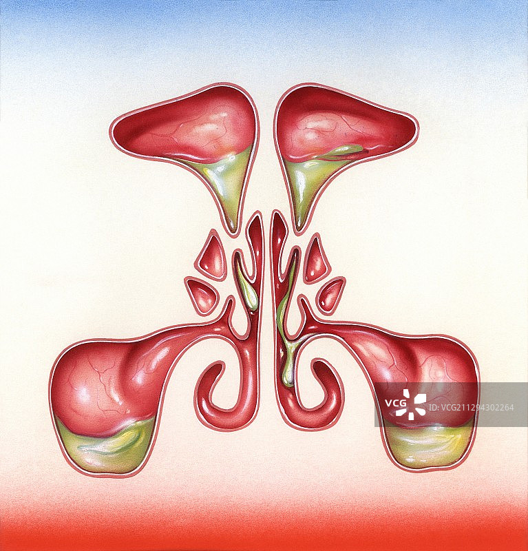 鼻窦炎插图图片素材