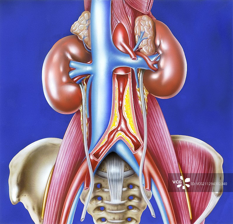 主动脉连接处的动脉粥样硬化图片素材