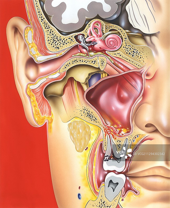 中耳、牙齿和鼻窦感染，图示图片素材