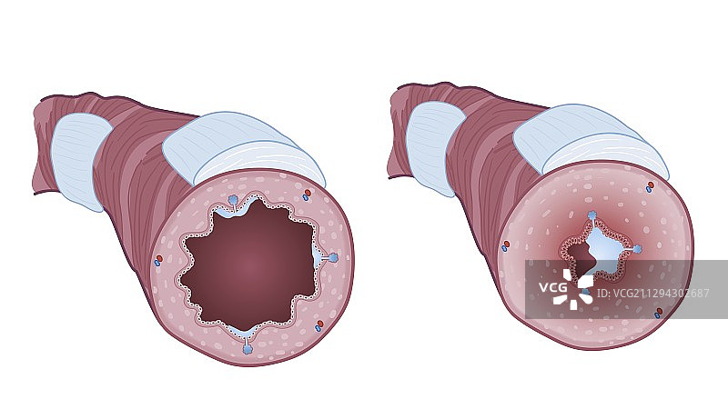 健康支气管与哮喘支气管插图图片素材