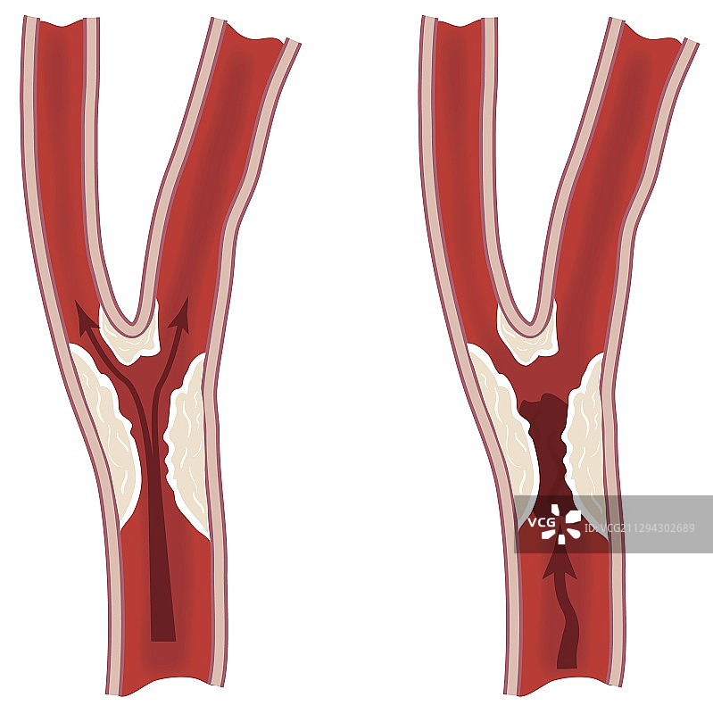 狭窄的颈动脉，图示图片素材