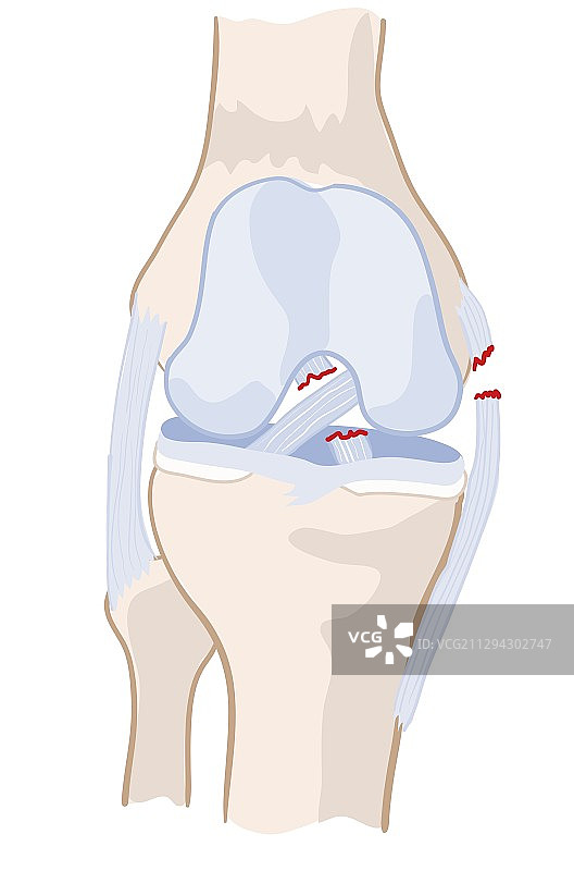 十字韧带损伤插图图片素材