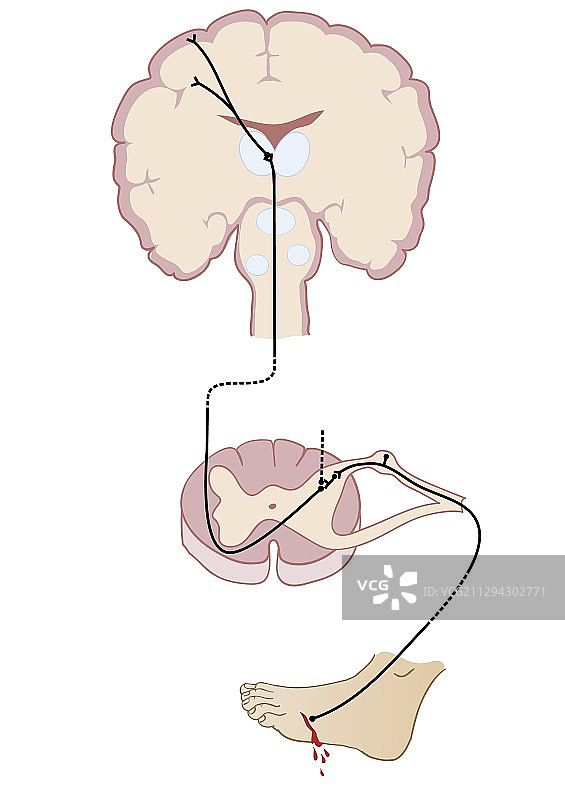 疼痛和脊髓丘脑束通路插图图片素材
