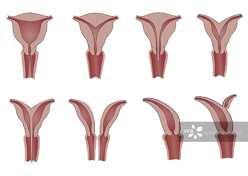 子宫畸形插图图片素材