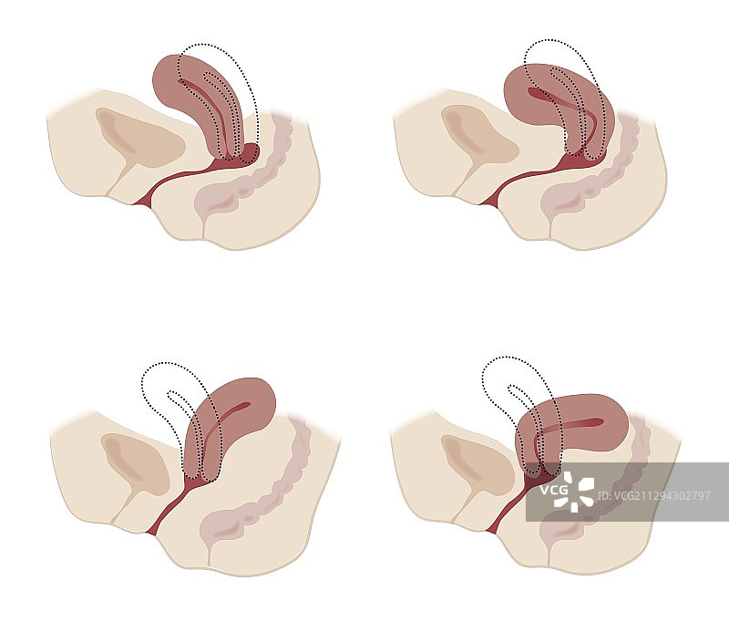 子宫解剖结构变异图示图片素材