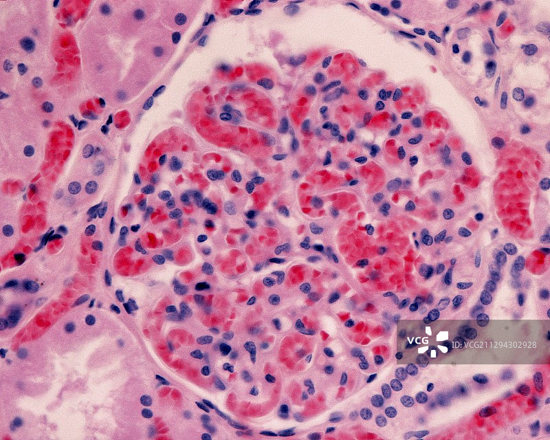 肾小球充血，光学显微照片图片素材