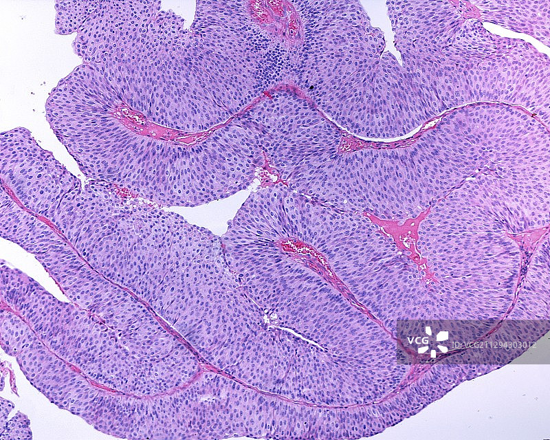 膀胱乳头状瘤显微照片图片素材
