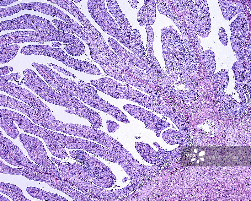 膀胱乳头状瘤显微照片图片素材