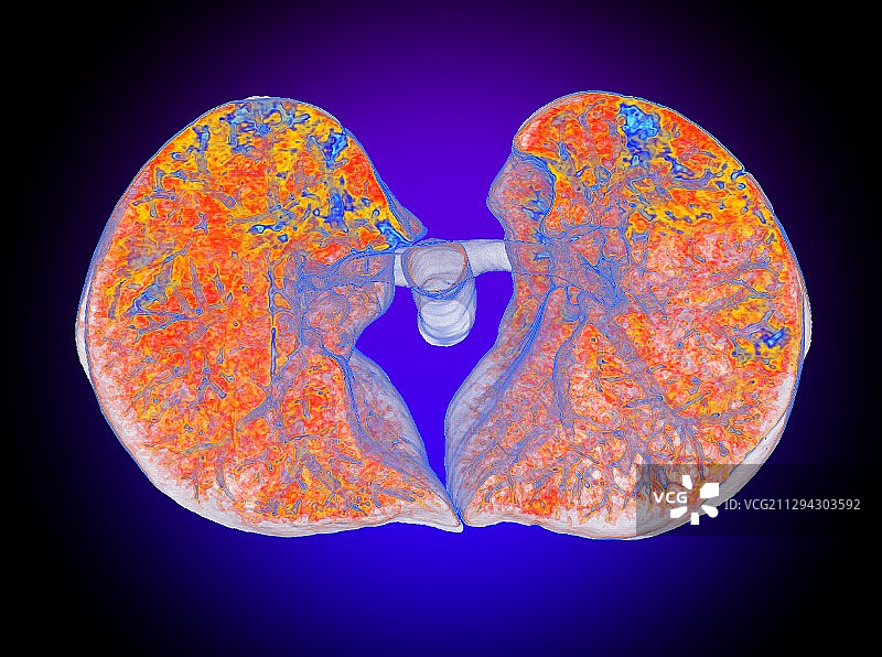 SARS-CoV肺损伤3D CT扫描图片素材