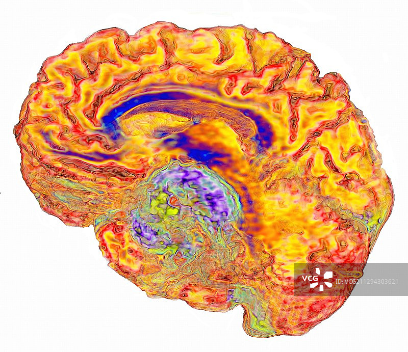 脑膜瘤脑癌3D核磁共振扫描图片素材