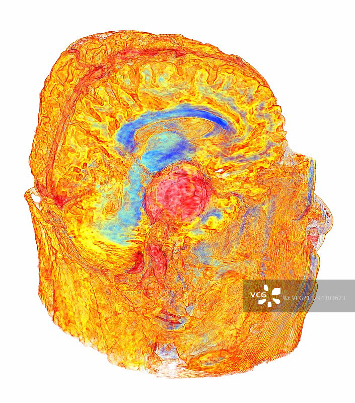 脑膜瘤脑癌3D核磁共振扫描图片素材