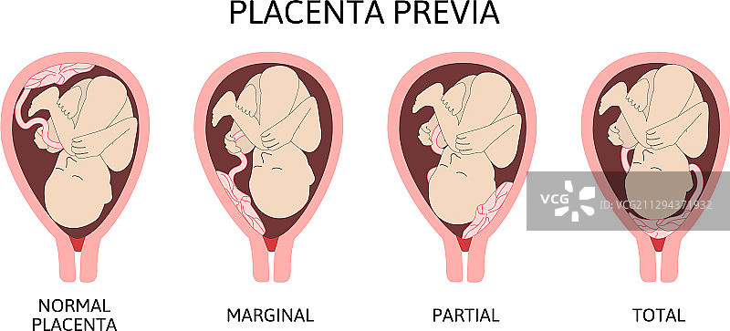 怀孕期间胎盘的不同位置图片素材