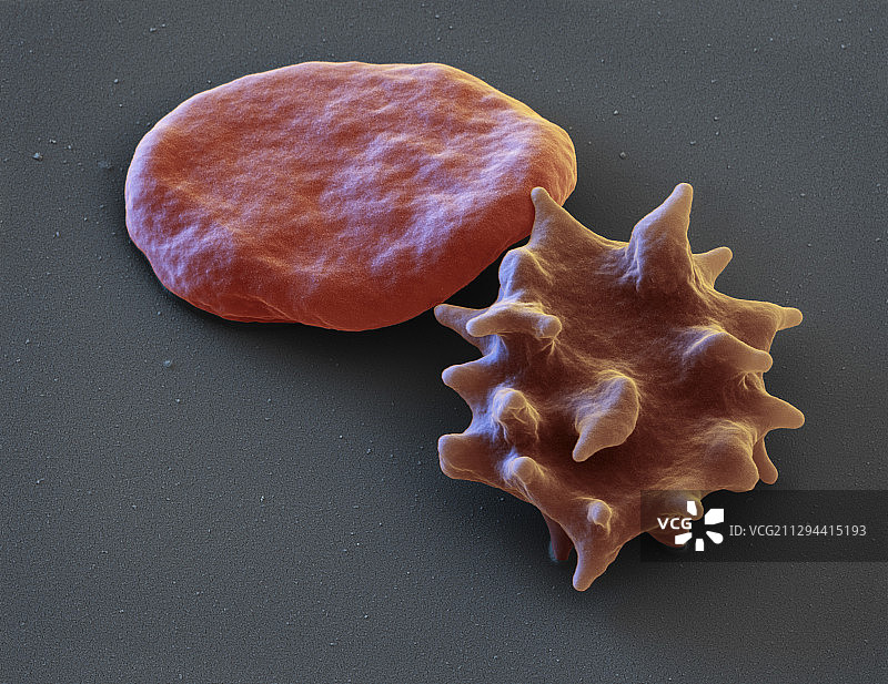 正常红细胞和棘细胞红细胞，扫描电镜图片素材