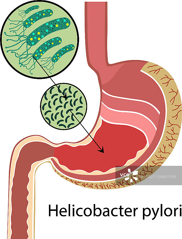 胃与幽门螺杆菌图片素材