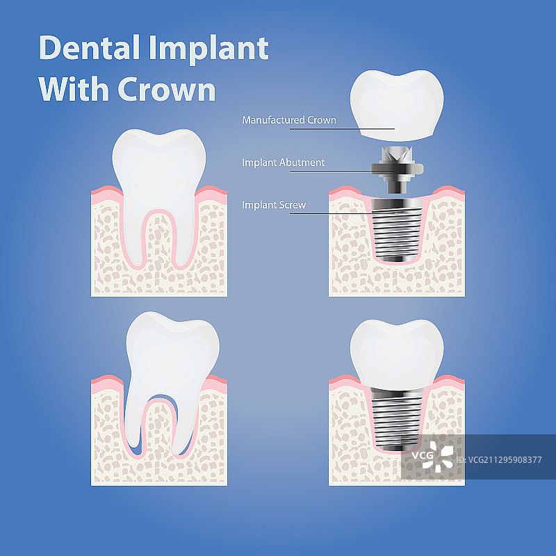 牙齿种植体与牙冠图片素材