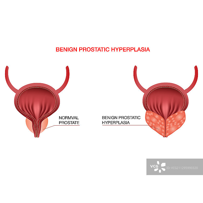 良性前列腺增生（可编辑）图片素材