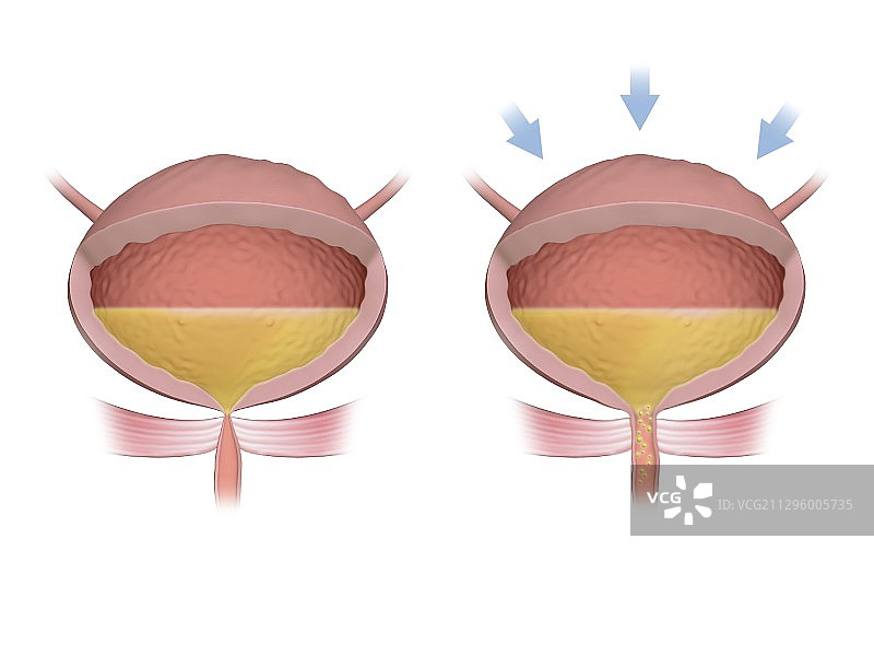 压力性尿失禁插图图片素材