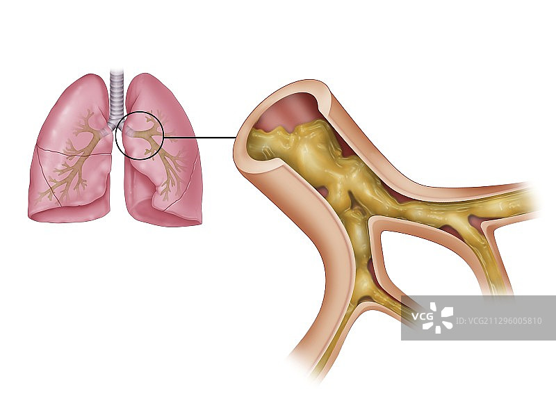 囊性纤维化示意图图片素材