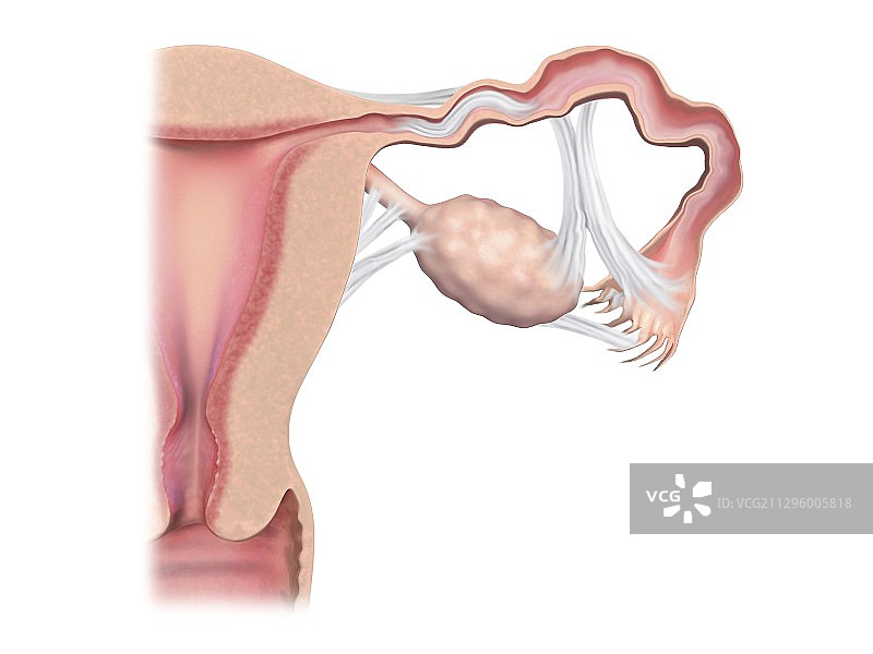 输卵管阻塞，图示图片素材